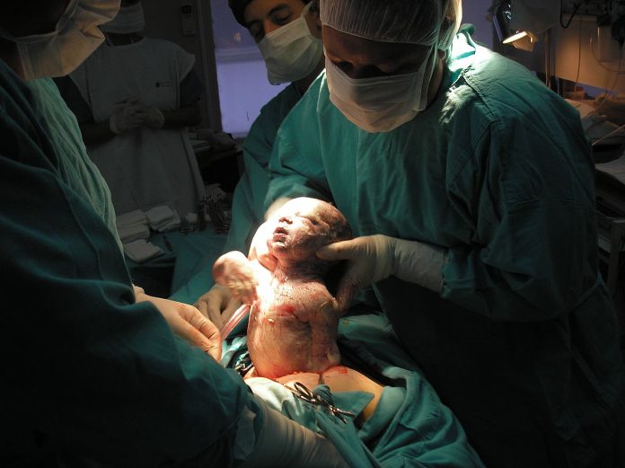 Foto de parto por cesárea para el artículo sobre cesárea en Paraguay